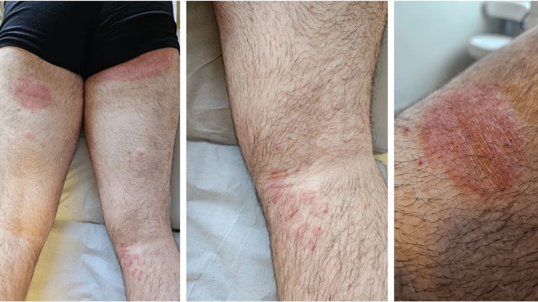 Brasil registra primeiro caso de fungo super-resistente