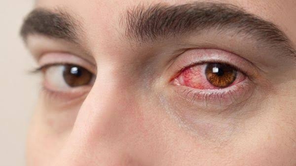 Mutirão oftalmológico na Paraíba: 29 pacientes têm complicações e sete passarão por cirurgia