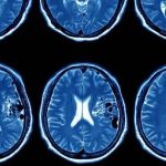 Avanço contra Câncer de Cabeça e Pescoço com Imunoterapia