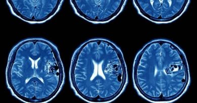 Avanço contra Câncer de Cabeça e Pescoço com Imunoterapia