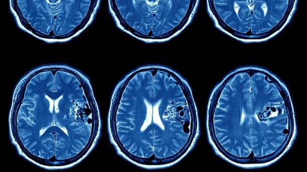 Avanço contra Câncer de Cabeça e Pescoço com Imunoterapia Avanço contra Câncer de Cabeça e Pescoço com Imunoterapia