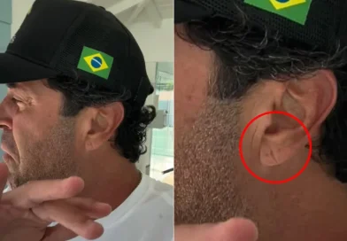 Você tem o ‘Sinal de Frank’? Marca na orelha pode ser alerta para infarto