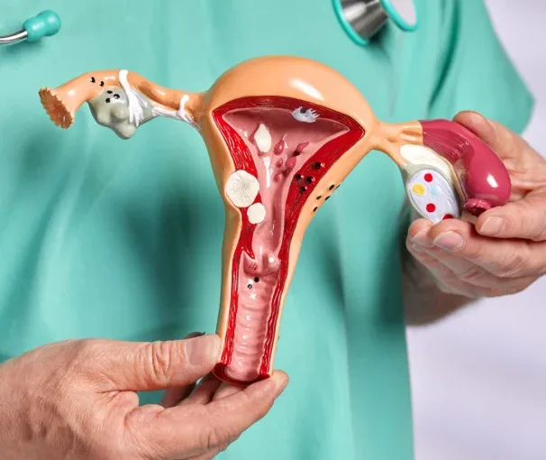 Endometriose: o silêncio de uma década que afeta uma em cada dez mulheres