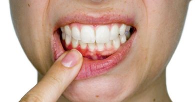 Saúde bucal negligenciada eleva risco de AVC em até 86% Saúde bucal negligenciada eleva risco de AVC em até 86%