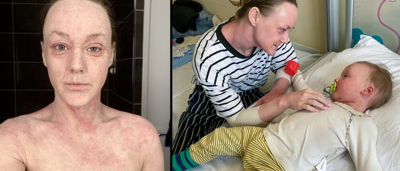 Retirada de Esteroides: O Que os Médicos Não Concordam