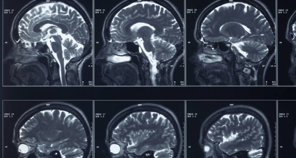 Implante Cerebral para Depressão Recebe Sinal Verde da FDA