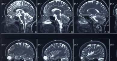 Implante Cerebral para Depressão Recebe Sinal Verde da FDA Implante Cerebral para Depressão Recebe Sinal Verde da FDA