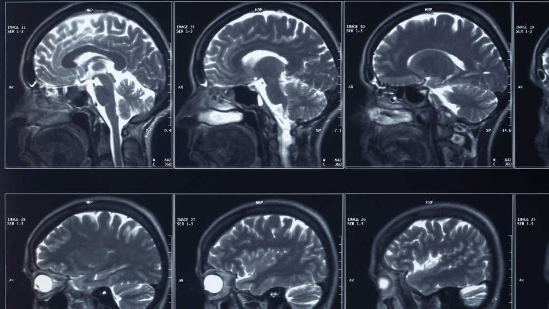 Implante Cerebral para Depressão Recebe Sinal Verde da FDA