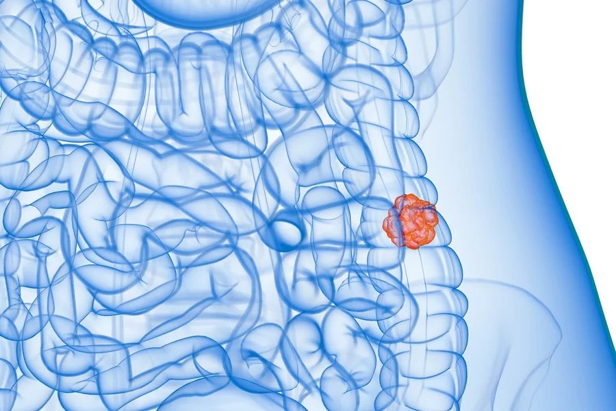 SUS adota teste de fezes para rastreamento de câncer de intestino